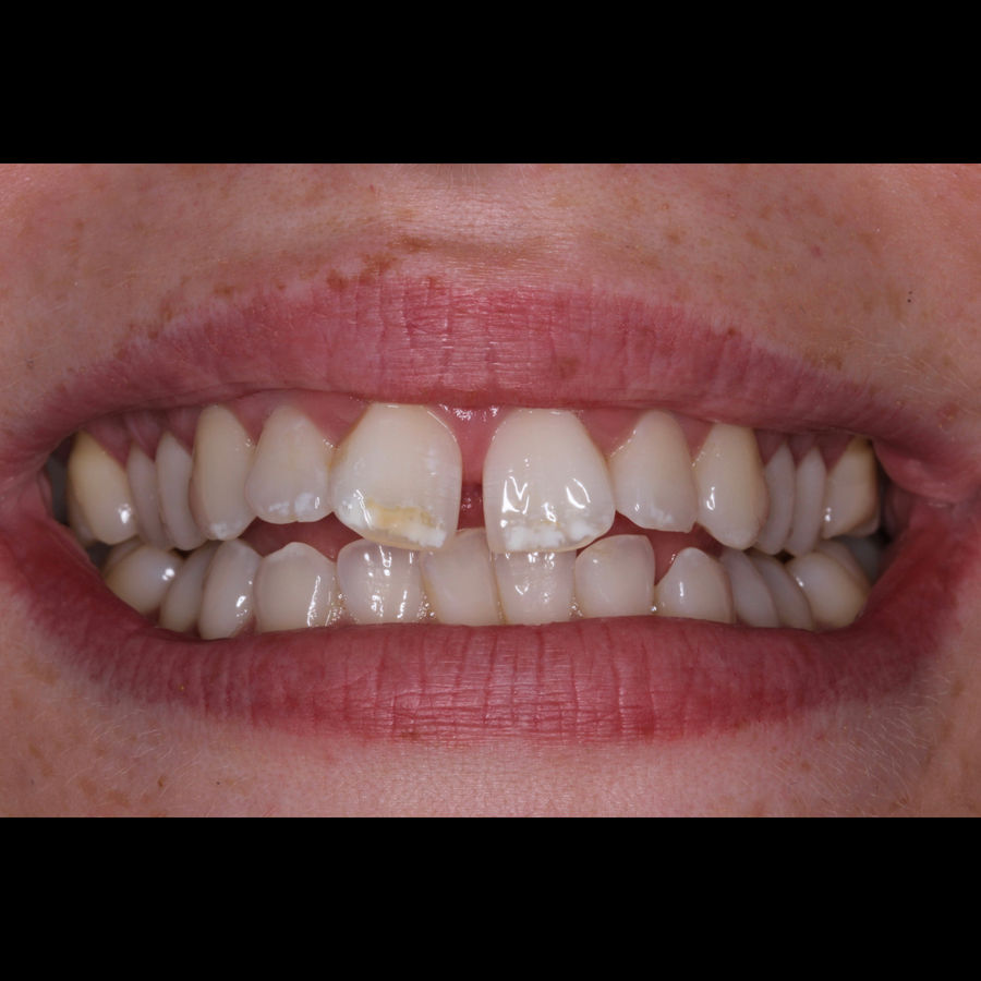 How 6 month braces work - Tara - before - 3Dental